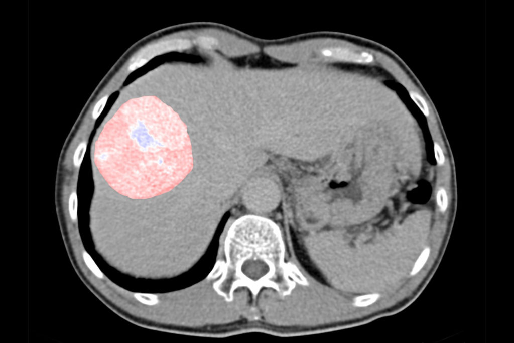 imaging of cancer in the liver